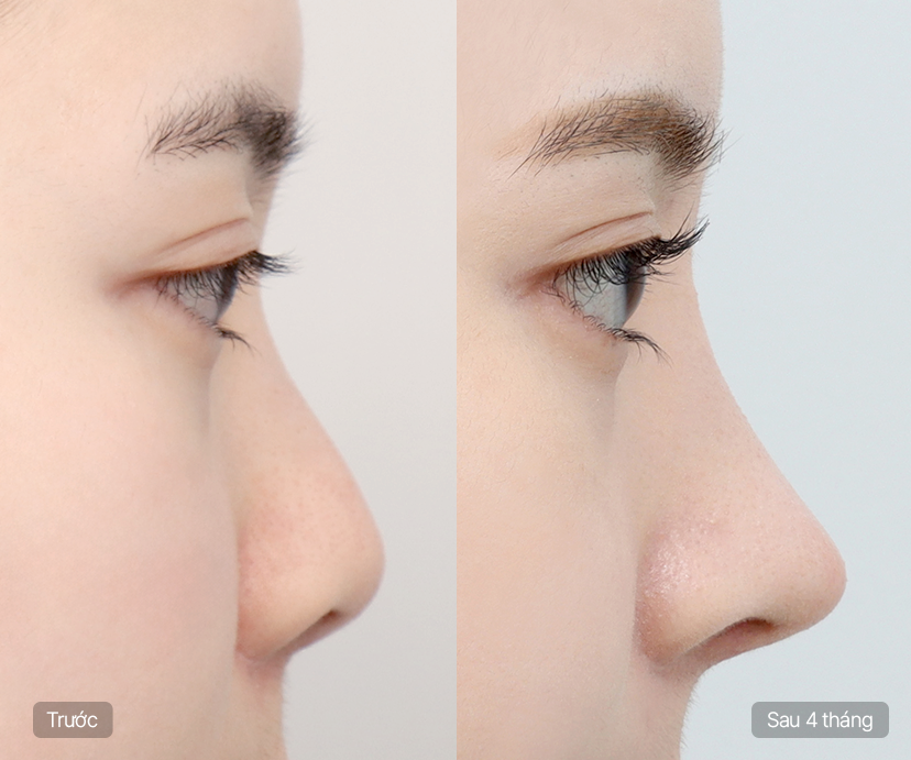 Short Nose Rhinoplasty