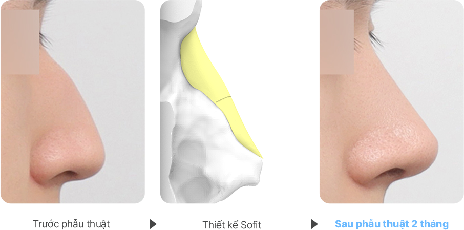 Severe Hump case