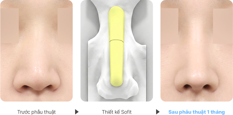 Deviated Nose case