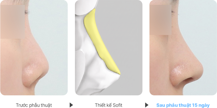 Contracted Nose case
