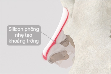 Nâng mũi thông thường