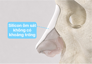 Nâng mũi 3D cá nhân hóa SOFIT