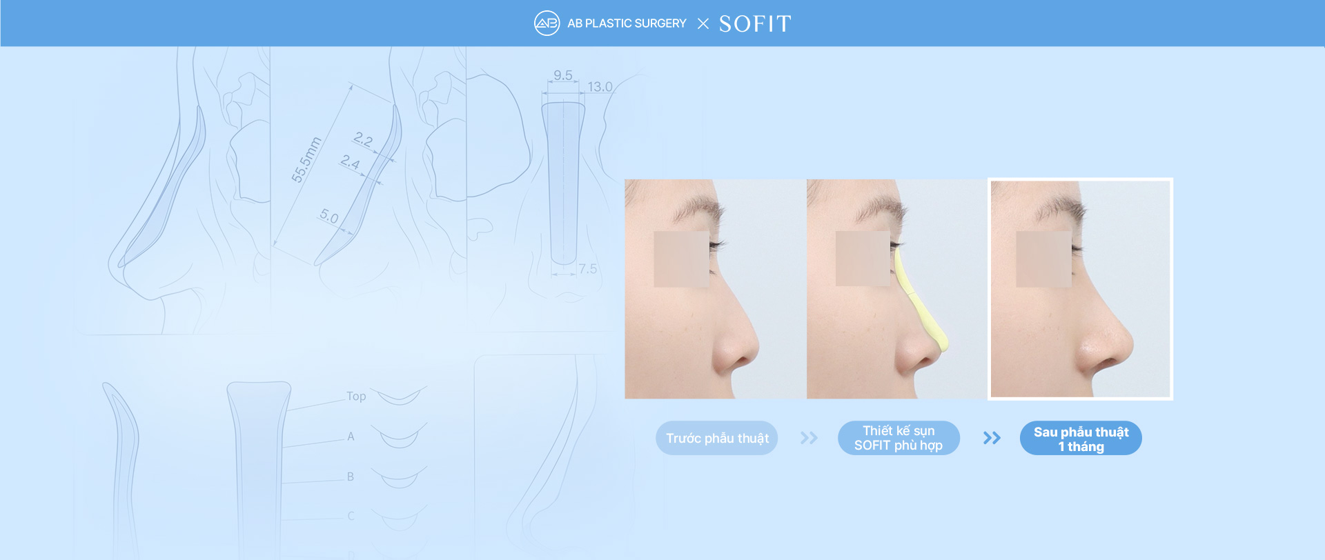 Sofit Nose