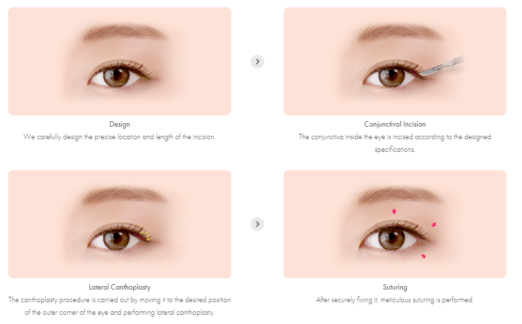 Canthoplasty bên