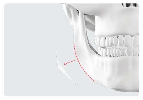 Phẫu thuật thu nhỏ hàm vuông Hàn Quốc