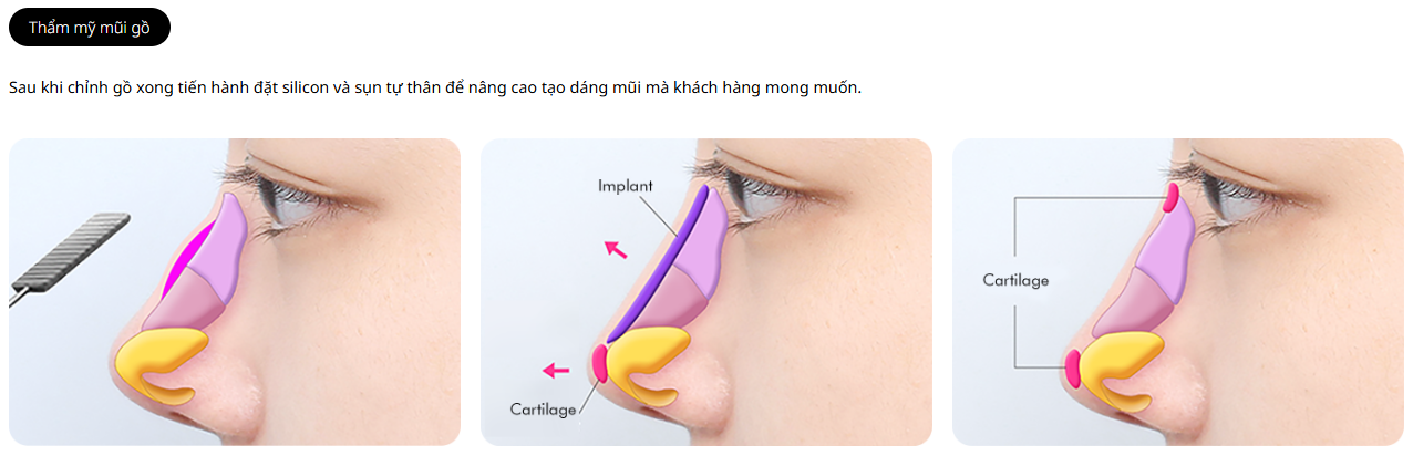 Nâng mũi bướu ở Hàn Quốc