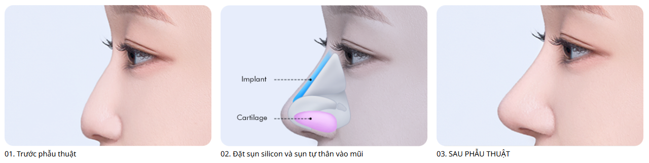 Nâng mũi phẳng Hàn Quốc