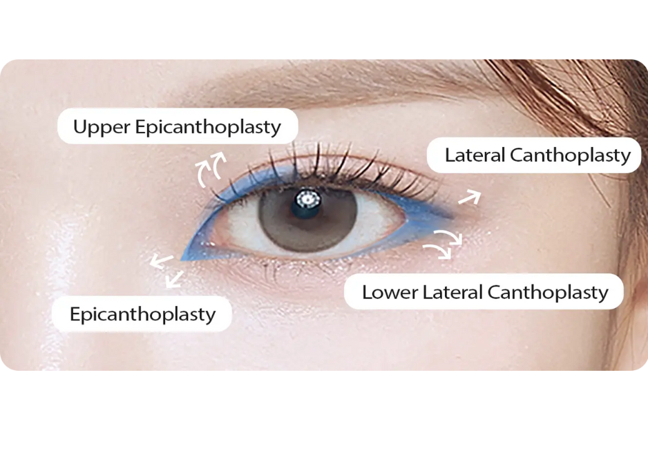 Các loại phẫu thuật mắt hạnh nhân