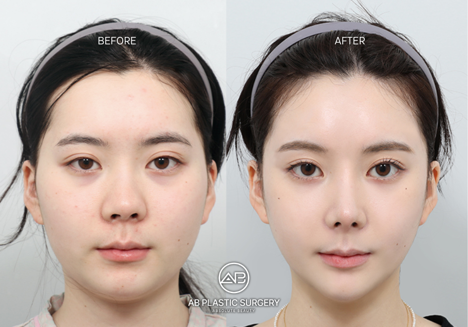 Phẫu thuật đầu cằm tại AB Plastic Surgery Korea