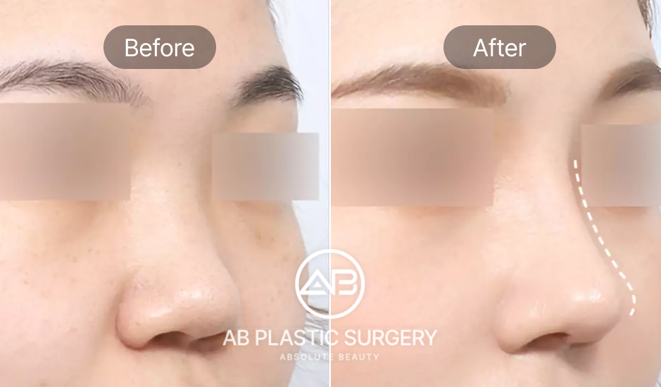 Trước và sau nâng mũi tự nhiên tại Bệnh viện thẩm mỹ AB