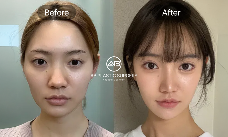 Trước sau hạ gò má tại Bệnh viện thẩm mỹ AB Hàn Quốc. Không sẹo, không đau, không chảy xệ. Phẫu thuật hạ gò má an toàn, hồi phục nhanh