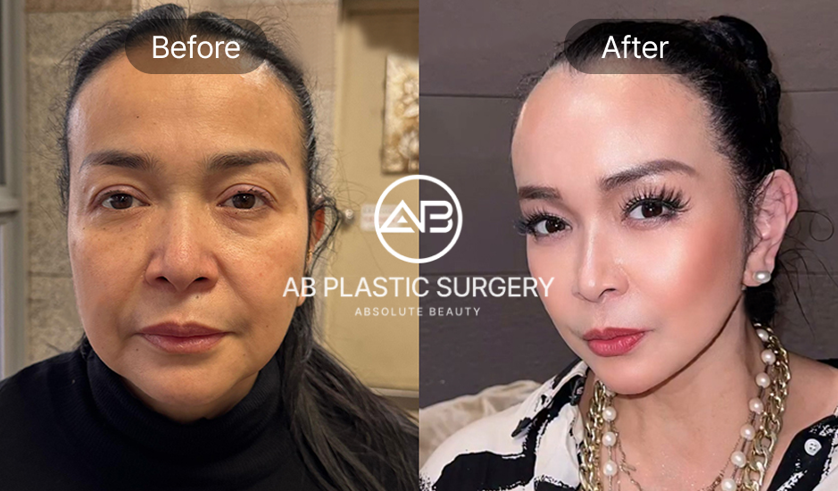 Hình ảnh Before & After liệu trình trẻ hóa da không phẫu thuật tại Bệnh viện thẩm mỹ AB Hàn Quốc – làn da săn chắc, khuôn mặt rạng rỡ và trẻ trung rõ rệt.