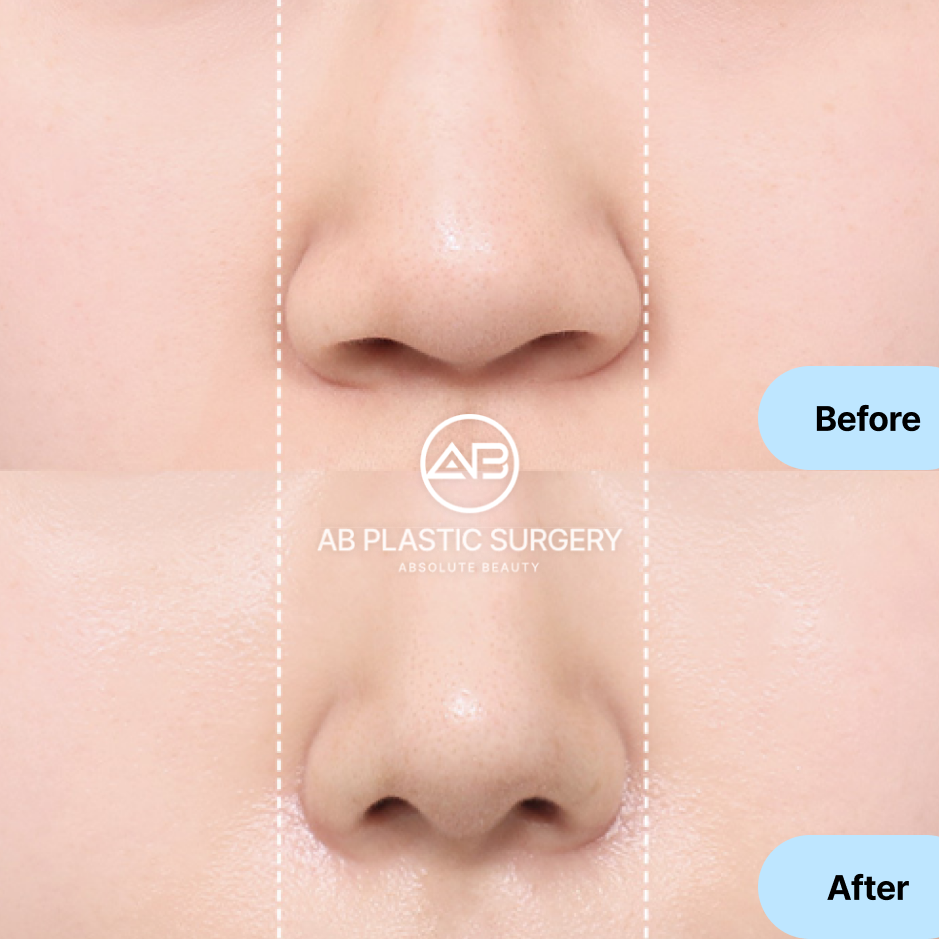 Hình ảnh trước sau thu nhỏ đầu mũi cho đầu mũi to củ hành tại Bệnh viện thẩm mỹ AB Hàn Quốc