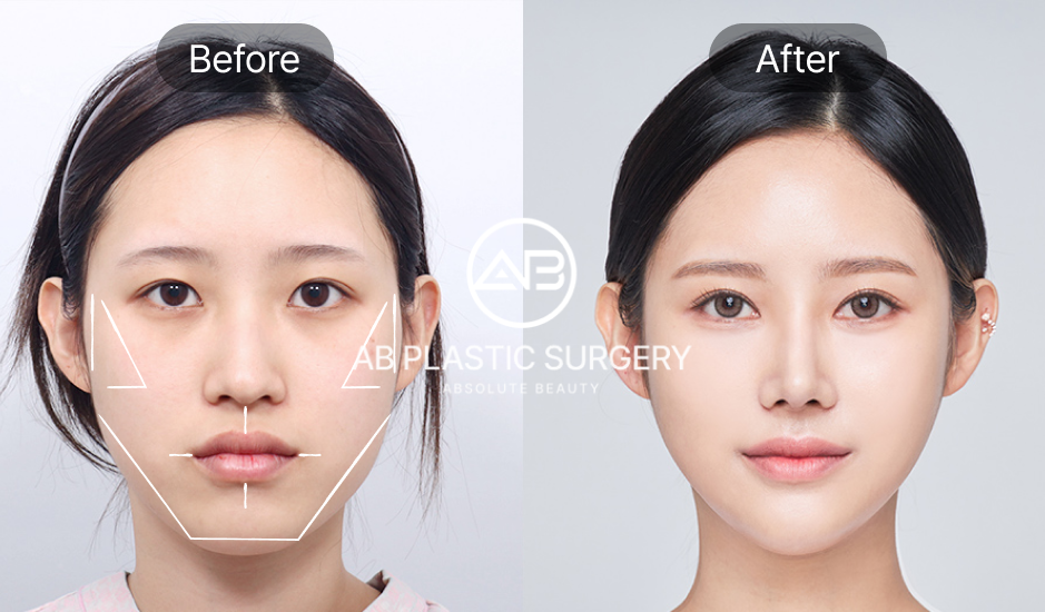 Ảnh trước sau phẫu thuật gọt hàm tại Bệnh viện thẩm mỹ AB Hàn Quốc – Thiết kế khuôn mặt chuẩn Hàn, tự nhiên và hài hòa