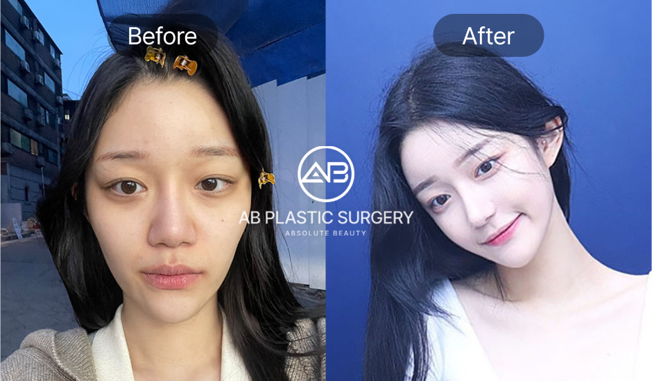 Hình ảnh trước sau thu nhỏ đầu mũi to, cải thiện đầu mũi bè tại Bệnh viện thẩm mỹ AB Hàn Quốc