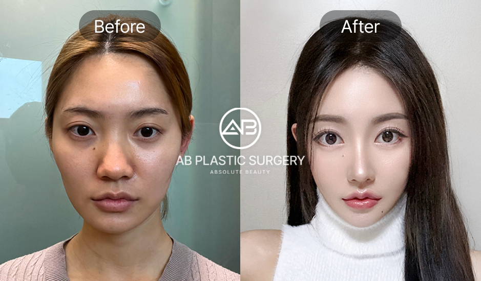 Hình ảnh trước sau thu nhỏ đầu mũi kiểu Hàn Quốc và các câu hỏi thường gặp