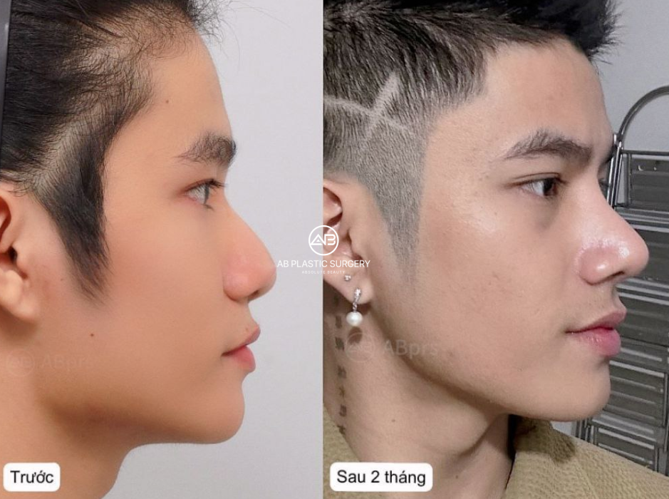 Hình ảnh trước và sau nâng mũi nam Hàn Quốc của TikToker Mai Tuấn Anh tại Bệnh viện thẩm mỹ AB Hàn Quốc, thể hiện dáng mũi cấu trúc tự nhiên phù hợp khuôn mặt nam giới