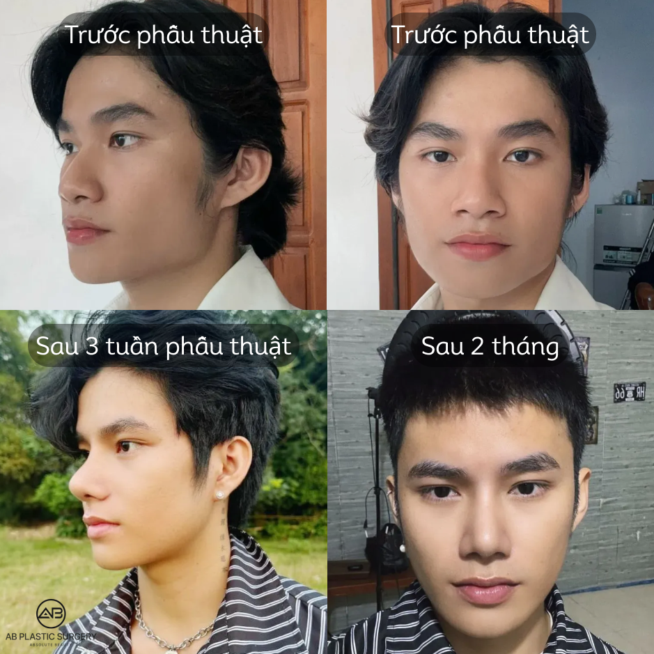 Hình ảnh trước và sau nâng mũi nam Hàn Quốc thay đổi theo thời gian hồi phục