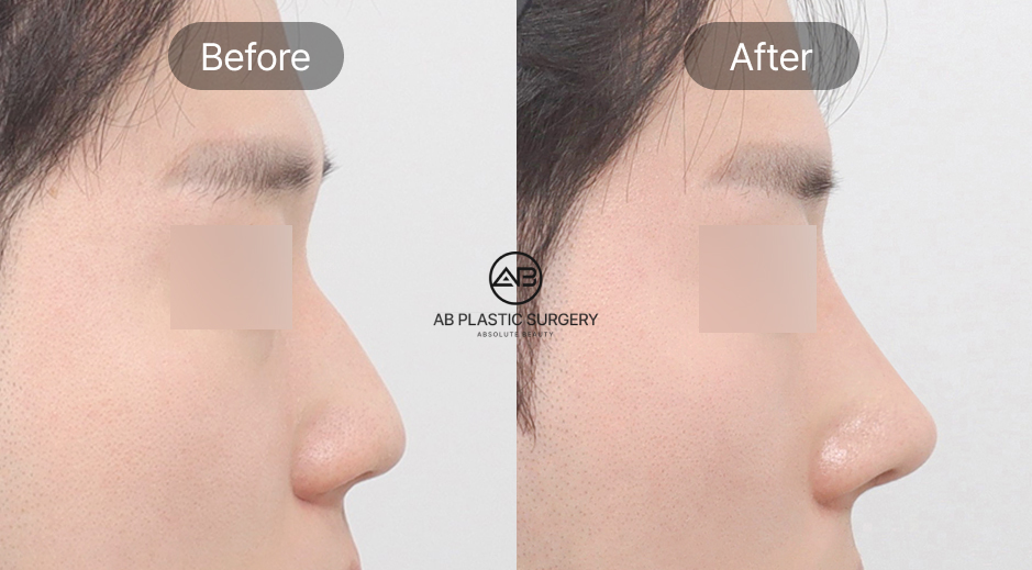 Hình ảnh trước và sau phẫu thuật mũi tại Bệnh viện thẩm mỹ AB Hàn Quốc, bao gồm chỉnh mũi to, mũi lệch, điều chỉnh góc mũi môi, mũi gồ, mũi chức năng và nâng mũi nam