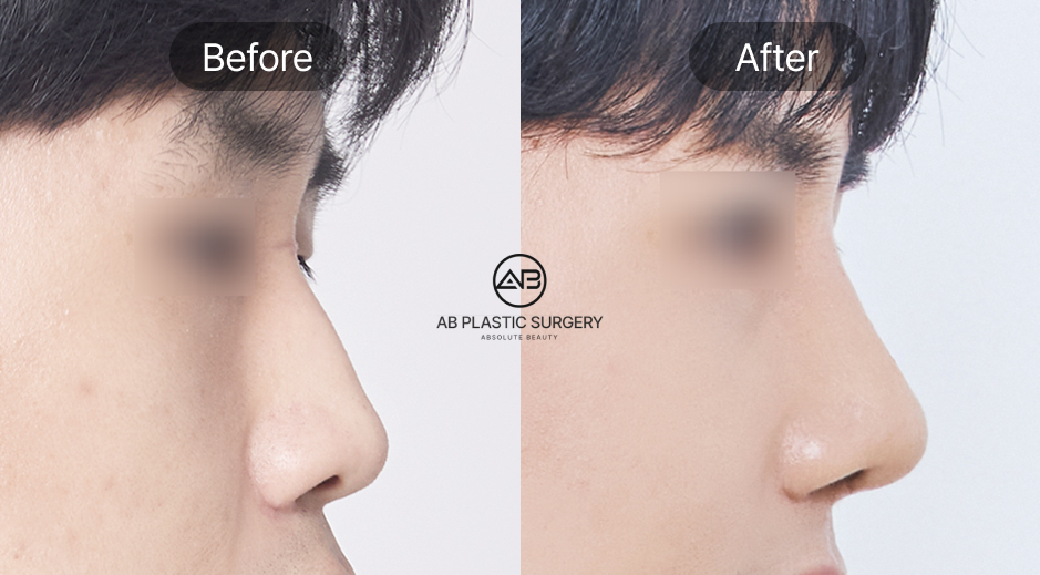 Hình ảnh trước và sau phẫu thuật mũi nam tại Bệnh viện thẩm mỹ AB Hàn Quốc, bao gồm chỉnh mũi to, thu gọn cánh mũi và mũi gồ giúp cải thiện tổng thể khuôn mặt