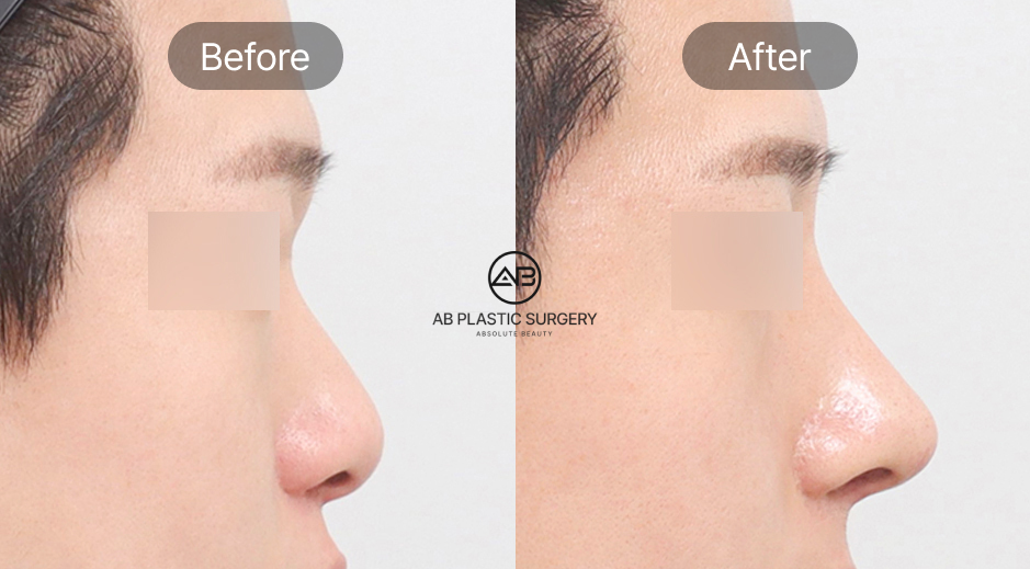 Trước và sau nâng mũi nam Hàn Quốc áp dụng kỹ thuật nâng mũi cấu trúc, chỉnh đầu mũi và thu gọn cánh mũi giúp dáng mũi thẳng tự nhiên