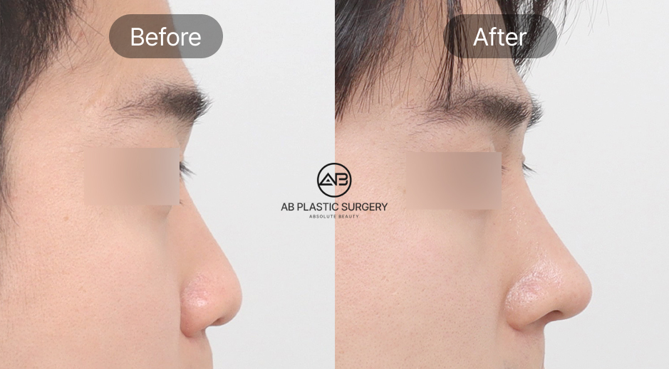 Trước và sau phẫu thuật mũi nam Hàn Quốc tại Bệnh viện thẩm mỹ AB Hàn Quốc, bao gồm chỉnh mũi to, thu gọn cánh mũi và chỉnh mũi lệch cho dáng mũi nam tự nhiên