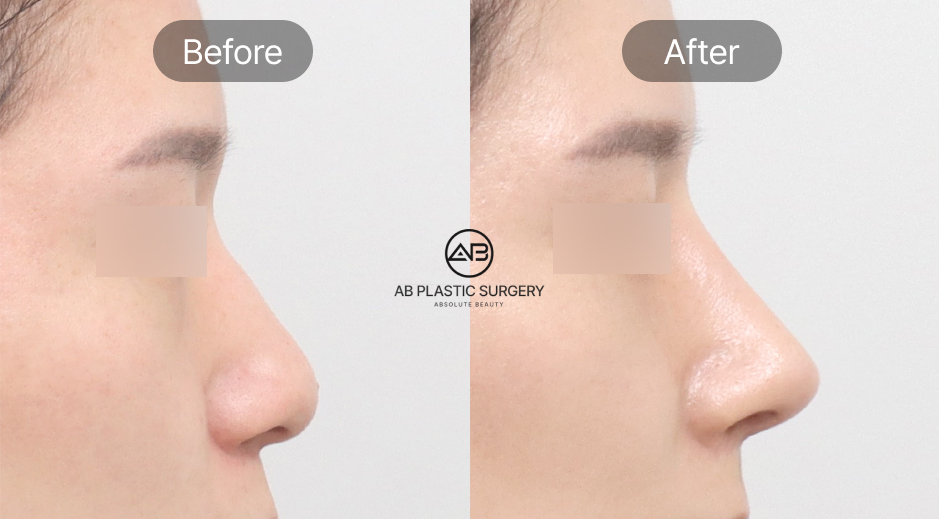Bệnh viện thẩm mỹ AB Hàn Quốc thực hiện phẫu thuật mũi nam Hàn Quốc trước và sau, bao gồm chỉnh mũi gồ, cắt xương mũi, chỉnh mũi lệch, cải thiện mũi to và phẫu thuật mũi chức năng
