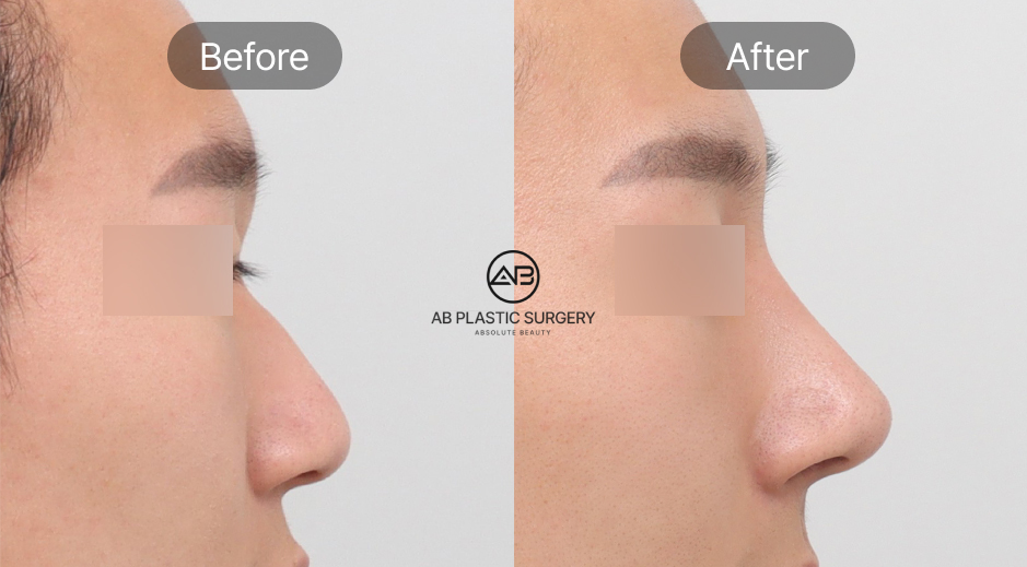 Trước và sau nâng mũi nam Hàn Quốc với quá trình hồi phục ổn định, giảm sưng theo từng giai đoạn